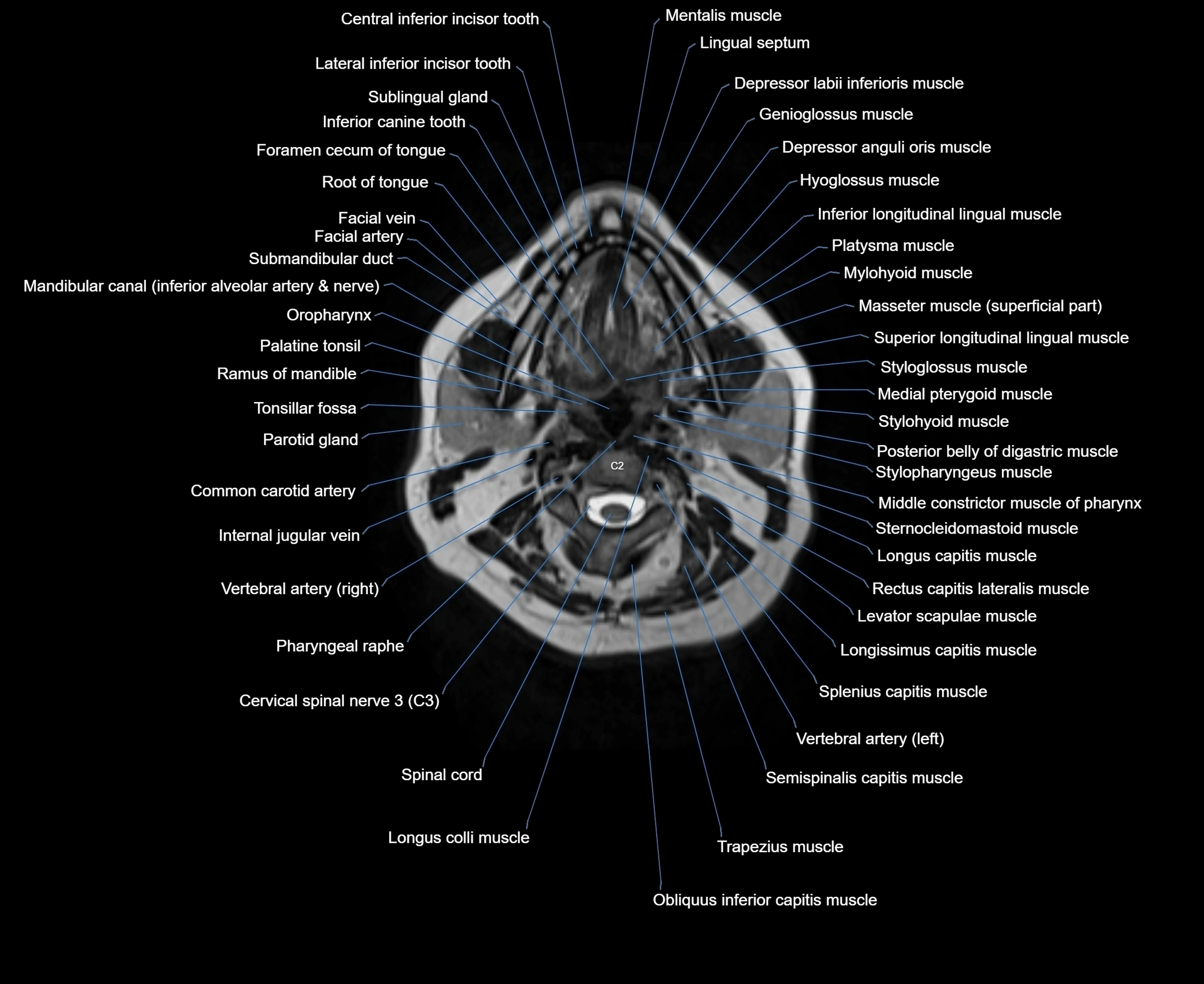 MRI Neck 3D labelled cross section anatomy axial 3t image-00001-00038.webp